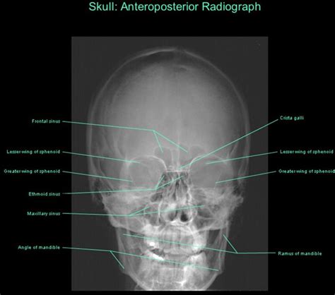 skull ap x ray anatomy